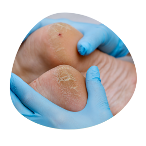 Behandeling van kloven en eelt Kloven en eelt aan de voeten tijdens een medisch pedicure behandeling